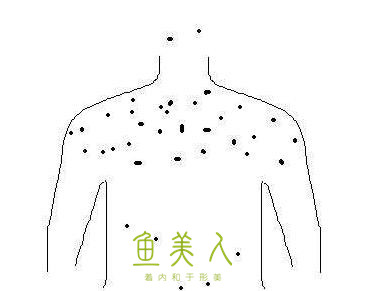 背上长痘痘该若何处置